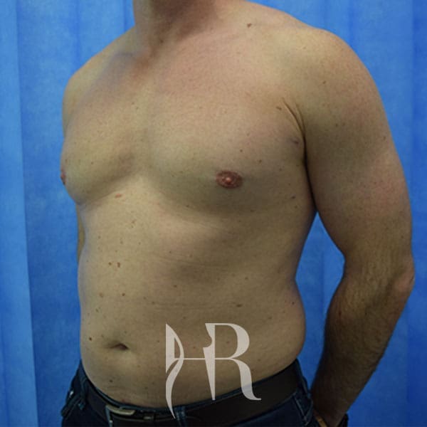 HR Plastic Surgery - Male Breast Reduction patient after 5